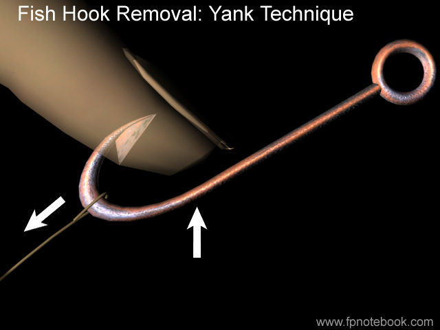 How To Remove A Fish Hook : String Yank Technique 