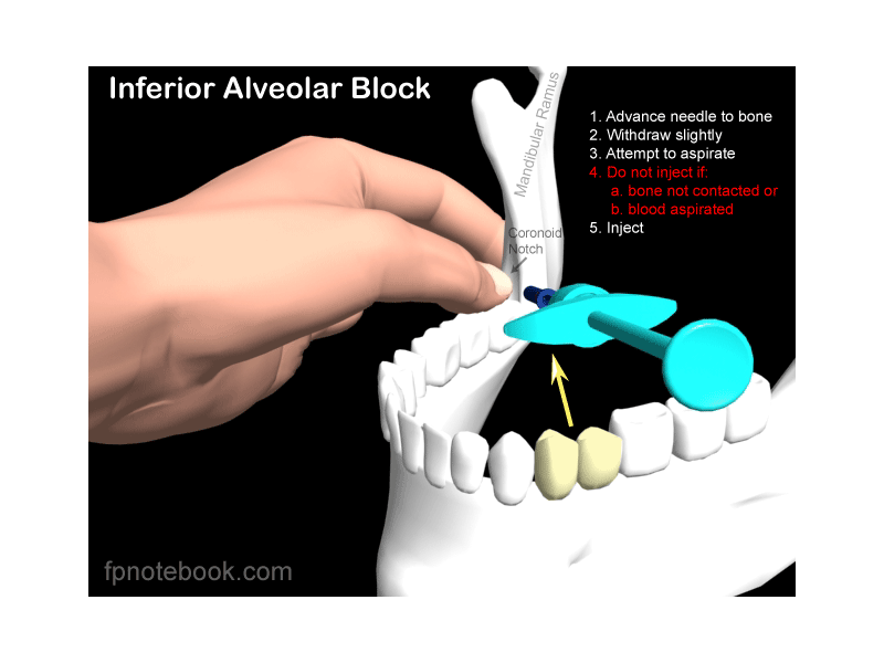 Inferior Alveolar Block