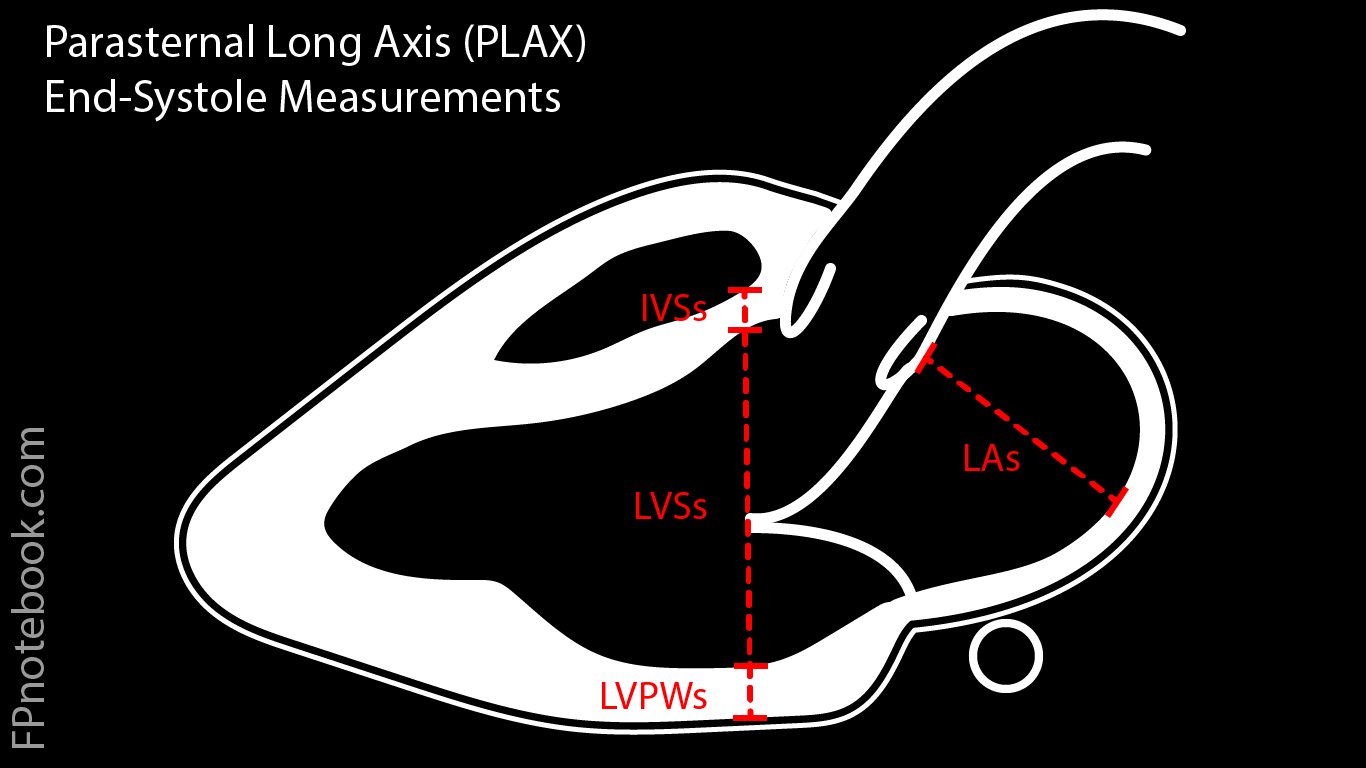 Parasternal Long-Axis Echocardiogram View