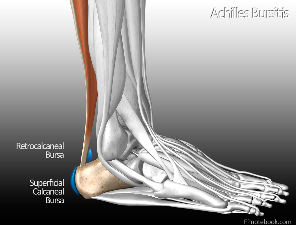 Achilles Tendon Bursitis Surgery DYHZ