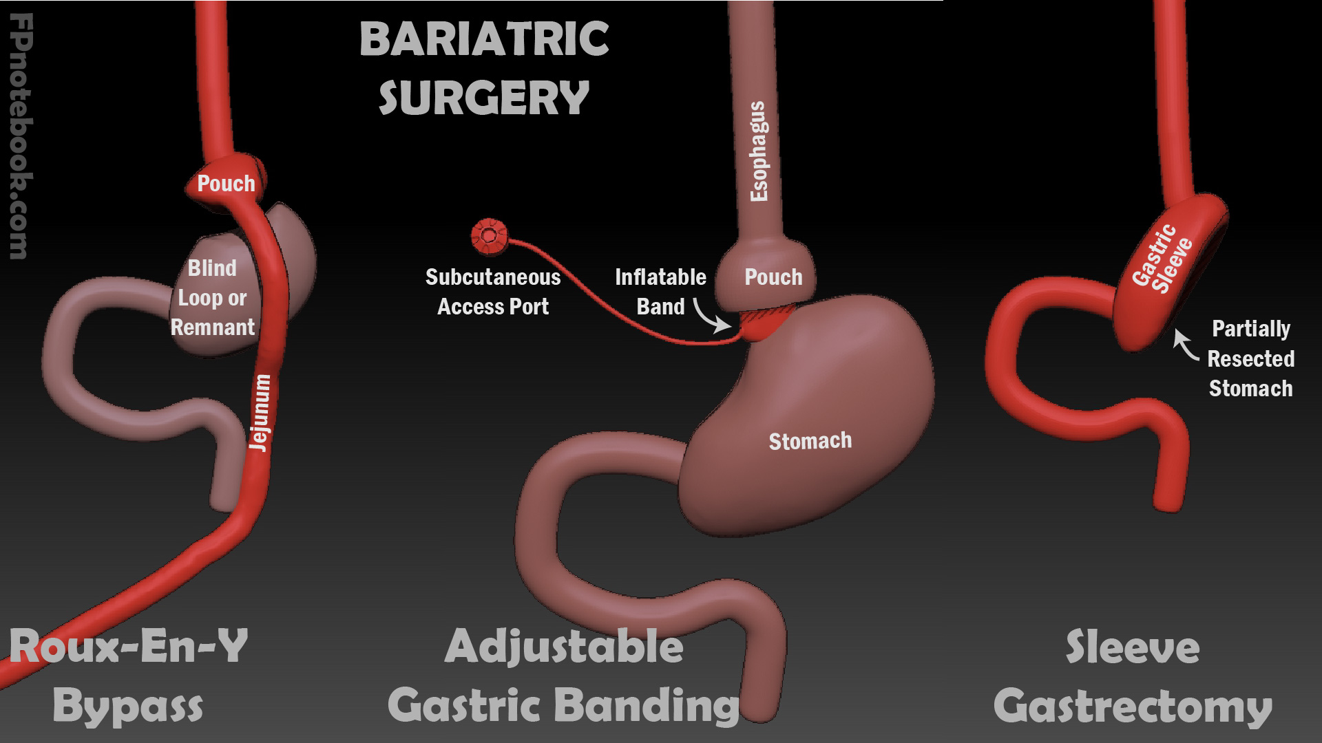 Understanding the Need for Gastric Bypass Surgery Revision