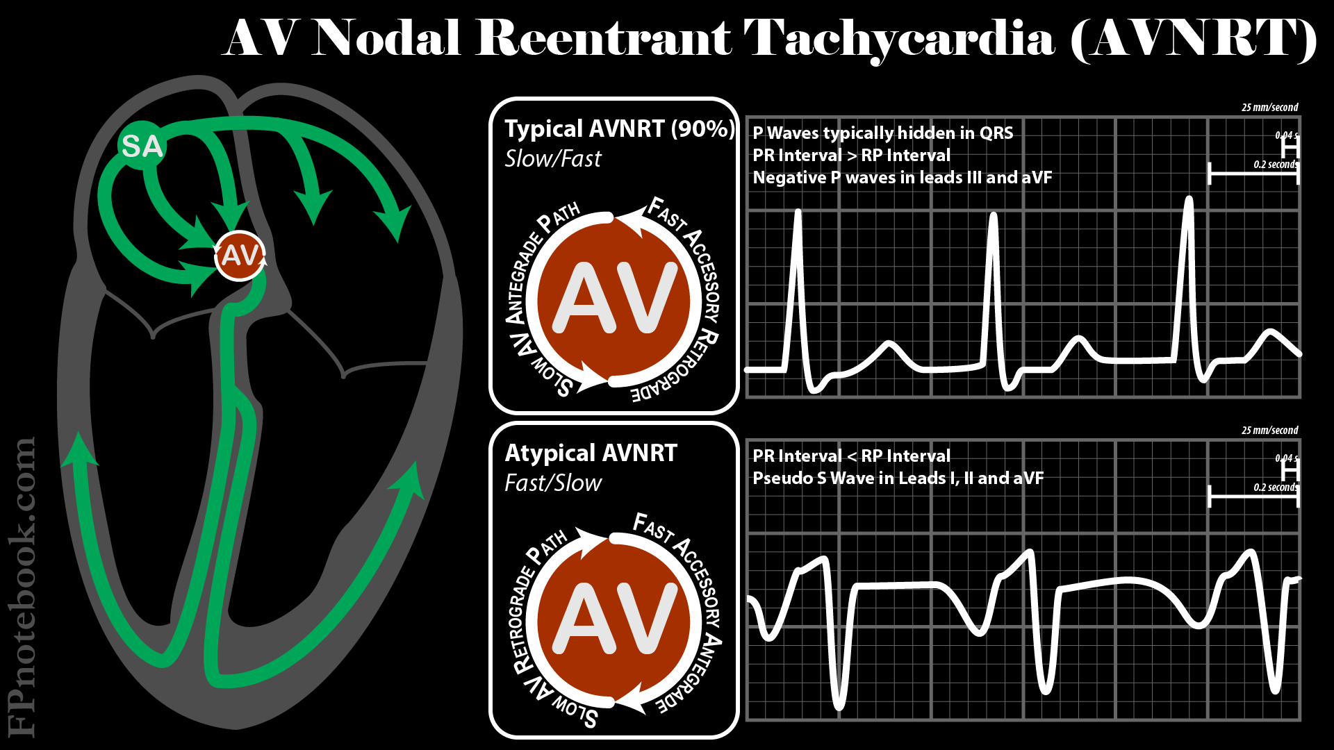 Reentry Supraventricular Tachycardia