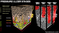 DermPressureUlcerStages.jpg