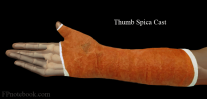 OrthoWristThumbSpicaCast.png