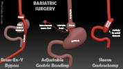 bariatricSurgery.jpg