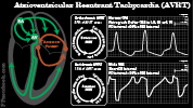 cv_ekg_svt_avrt.png