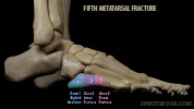 orthoFootFifthMetatarsalFracture.jpg