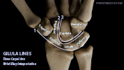 orthoWristXrayGilulaLines.jpg