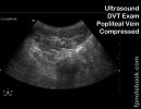 ultrasoundBMP_DVTEval_poplitealCompressed.jpg