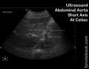 ultrasoundBMP_abdAortaSAXatCeliac.jpg