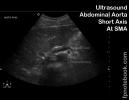 ultrasoundBMP_abdAortaSAXatSMA.jpg