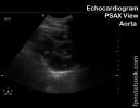 ultrasoundBMP_cvPSAX_aorta2.jpg