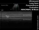 ultrasoundBMP_lungPtxEvalMModeAbnl.jpg